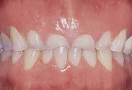 Bruxism